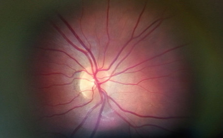 retina